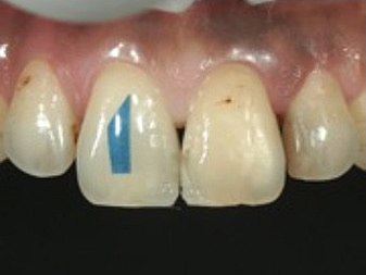3Dマトリックスによる歯頸部カントゥアの再現