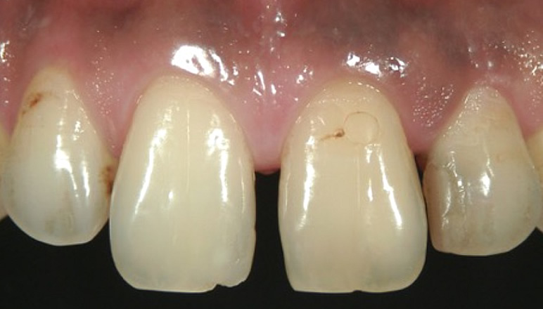 前歯離開歯列への修復<br>STEP1　仮充填・修復前準備