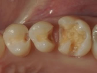 感染象牙質除去・窩洞形成終了