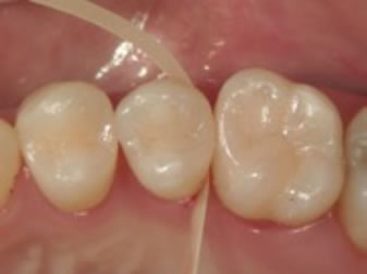 歯肉側窩縁の移行部研磨操作