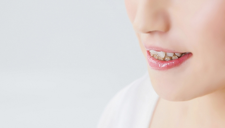 矯正治療中でも効果的な<br>プラーク除去が期待できる<br>音波式電動歯ブラシの威力