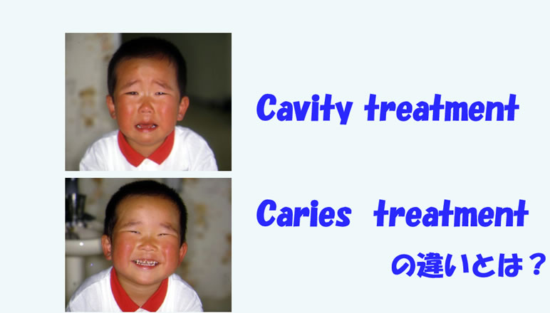 日本の小児の齲蝕減少の歴史 その3  “Cavity treatment”と”Caries treatment”