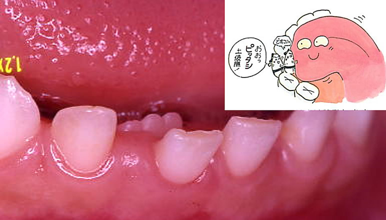 発達期における咬合の変化 その3<br>萌出力と下顎犬歯間幅径の増加