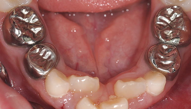 発達期における咬合の変化 その4下顎乳犬歯近心のスライスカット