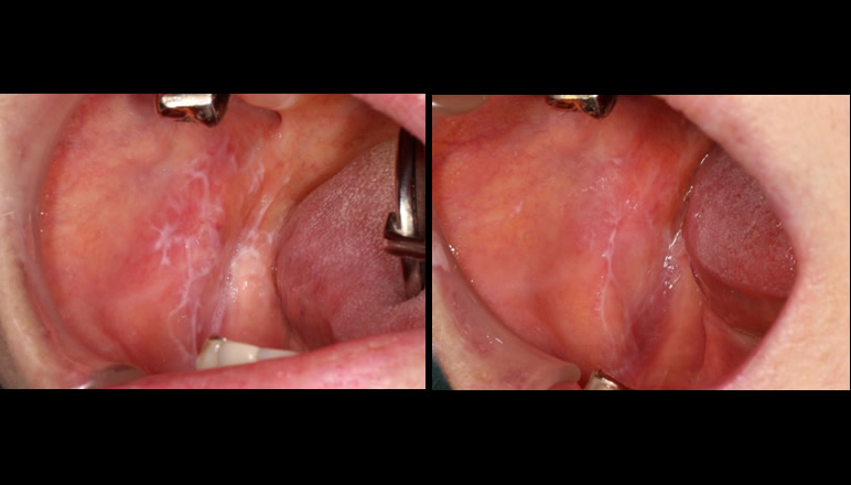 常在菌の役割を理解して口腔粘膜の管理を行おう！第4回：口腔扁平苔癬について