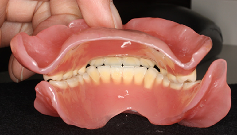 全部床義歯臨床ワンポイント講座～知っておくと役立つ基礎知識 第2回 成功する秘訣!”現義歯を良く診よう”