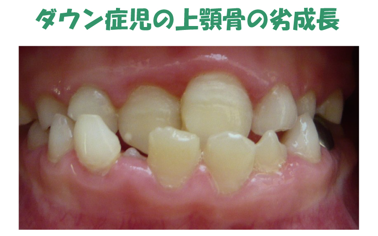 発達期における咬合の変化 その9 切歯骨の舌圧