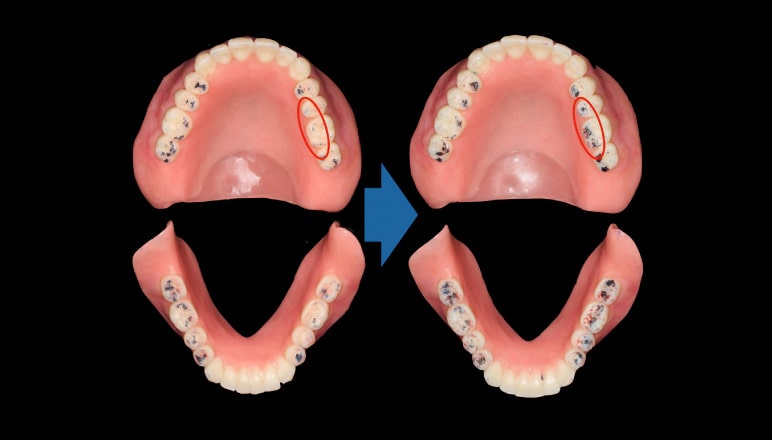 全部床義歯臨床ワンポイント講座～知っておくと役立つ基礎知識 第11回　無歯顎でも絶対必要な“義歯のリコール”