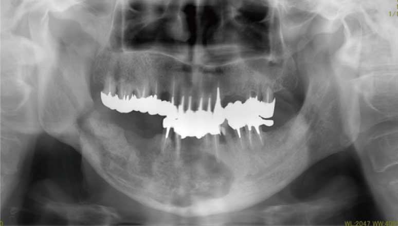口腔外科診療のエビデンスを考える 第2回：薬剤関連顎骨壊死－その1－